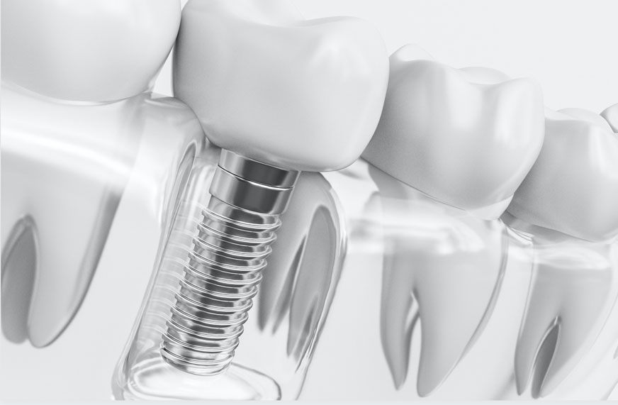 konya implant, konya implant fiyatları, konyada implant fiyatları, implant diş fiyatları konya, implant fiyatları 2024 konya, implant fiyatları konya, implant konya, konya implant diş fiyatları, konya implant merkezi, konya implant tedavisi, konya implant yapan hastaneler, konya implant yapan yerler, konyada implant yapan doktorlar, konyada implant yapan hastaneler